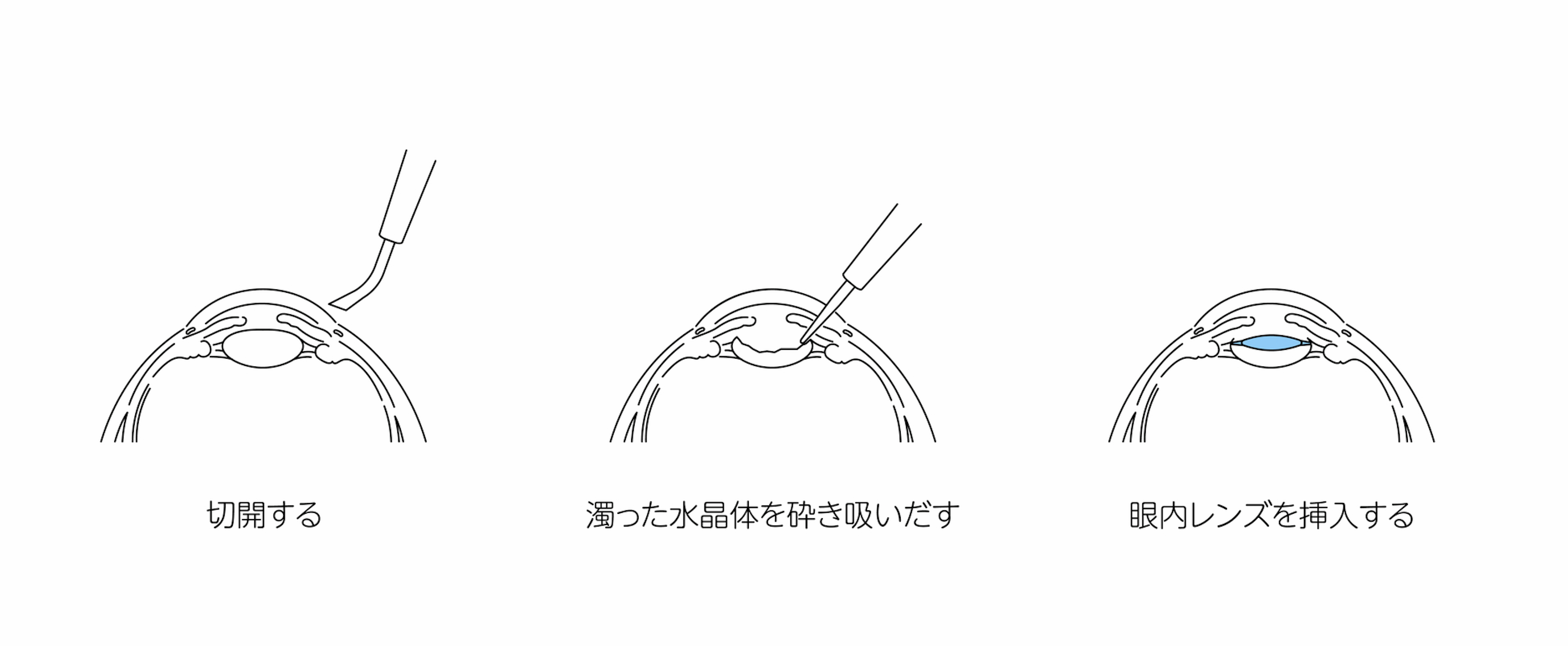 手術当日のイメージ